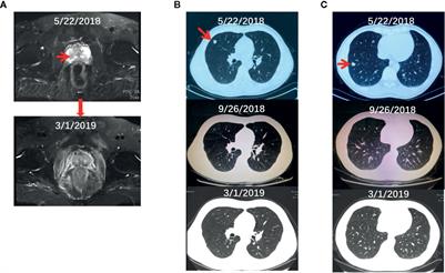 Case Report: Co-Existence of BRCA2 and PALB2 Germline Mutations in Familial Prostate Cancer With Solitary Lung Metastasis